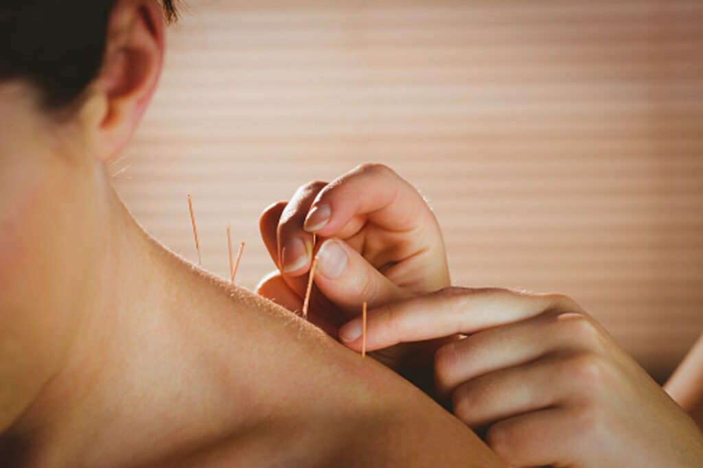 Precisely how Acupuncture Can Help Your Body 1 NYC acupuncture