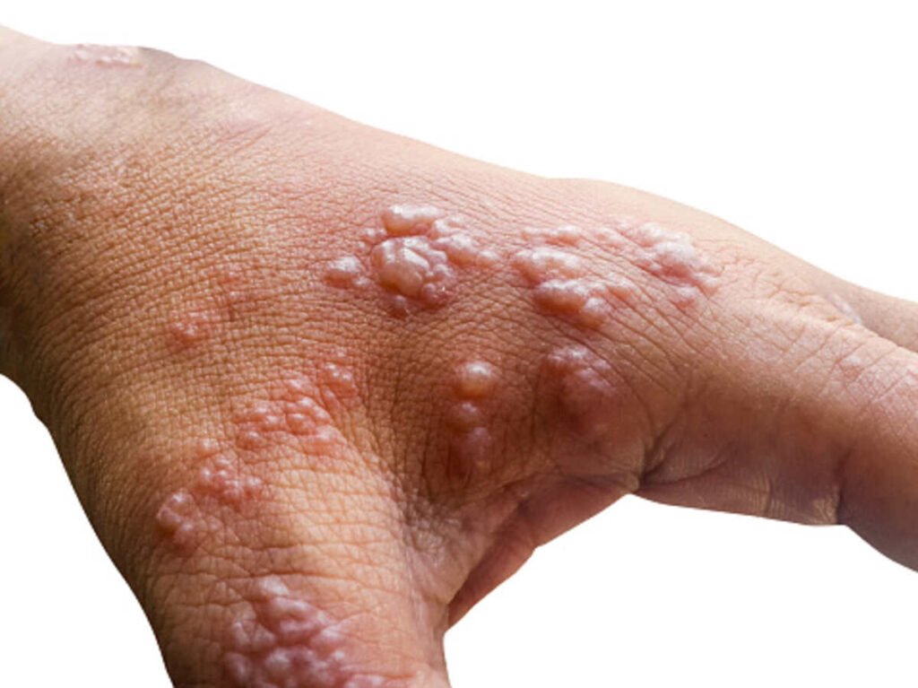 Herpes Symptoms 1 herpes symptoms