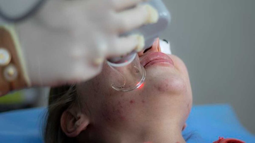 Get rid of Acne - Things To Steer clear of 1 How to Eliminate Acne