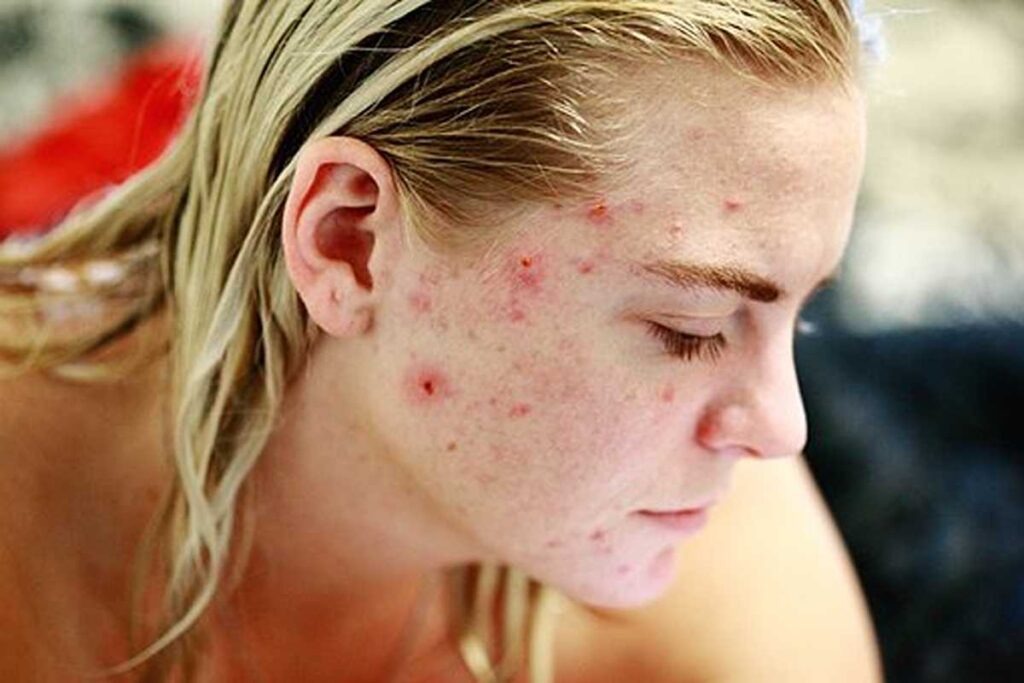 How to Care for Acne Prone Skin