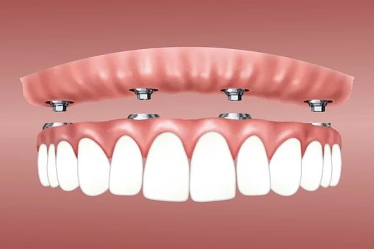 clear choice dental implants cost reviews