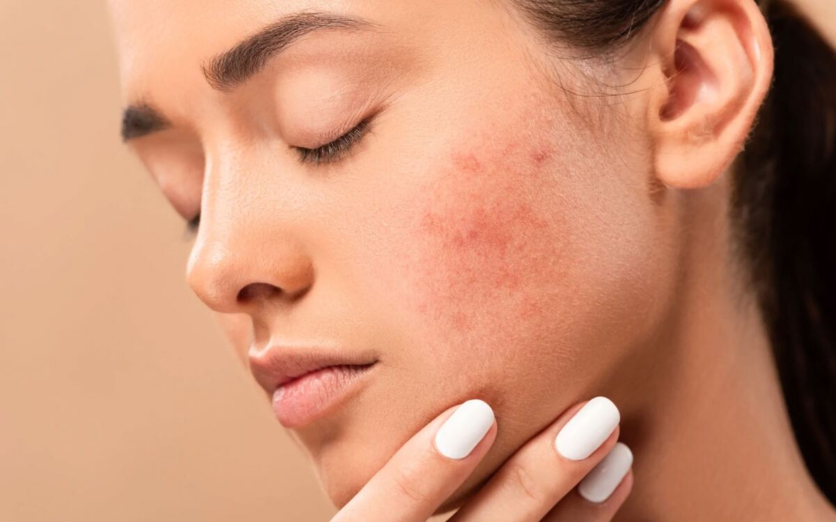 acne scars treatment in Bangalore