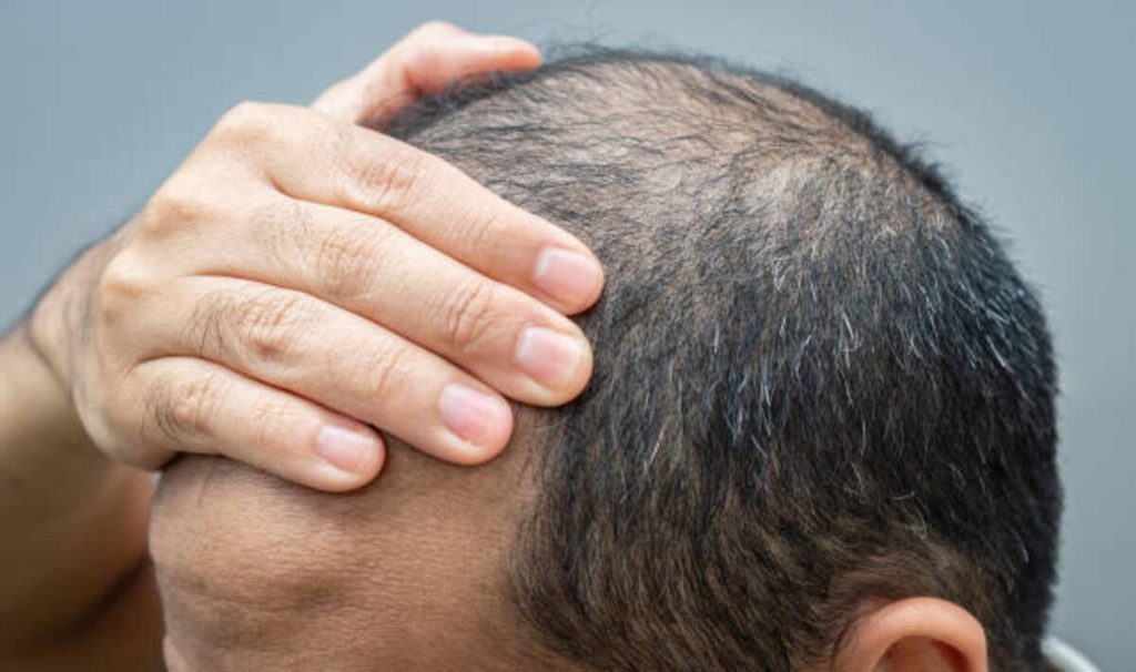Hair Transplant Results 1 Follicular unit extraction clinic in ARIZONA