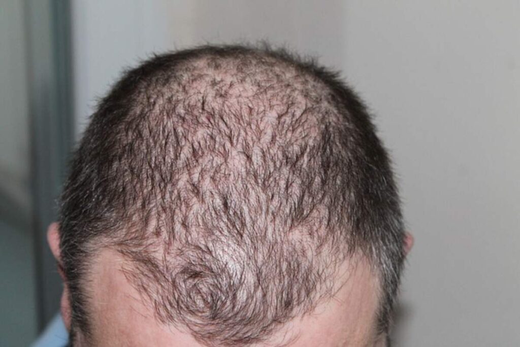 PRP For Hair Loss 1 Hair loss PRP