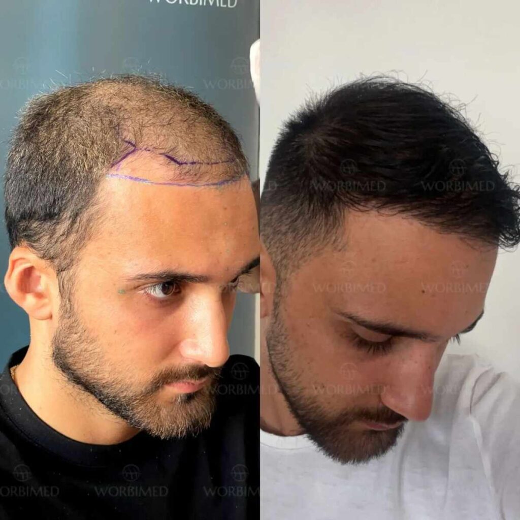 Is the Low Hair Transplant Price in Turkey Really Worth It? 1 Hair transplant